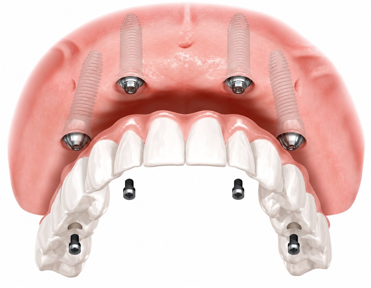 Ilustração: arcada de cima com dentes fixos presos sobre implantes